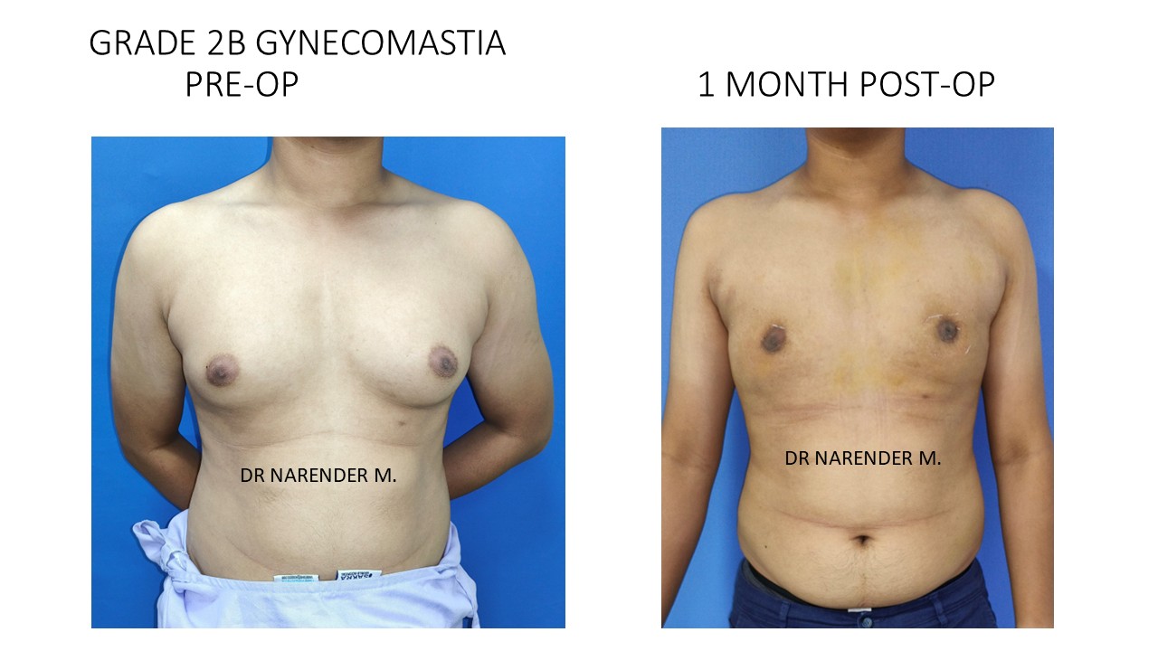Gynecomastia Photo 3